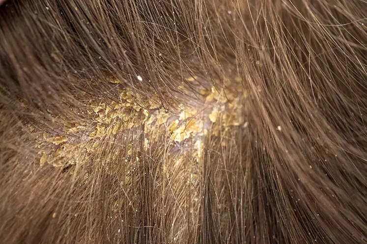 Seboreik Dermatit Kimlerde Görülür? Tedavi Yöntemleri Nelerdir?