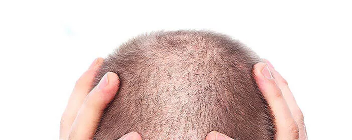 Saç Dökülmesi Nedir, Saç Dökülmesi Tipleri Nelerdir ?