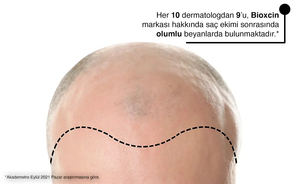 Saç Ekimi Acıtır mı?