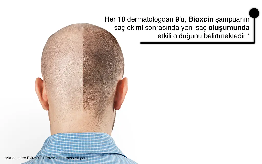Saç Ekimi Tedavi Süreci Ne Kadardır? 