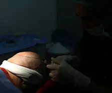 Saç Ekiminden Sonra İlk 20 Gün Nelere Dikkat Edilmeli?