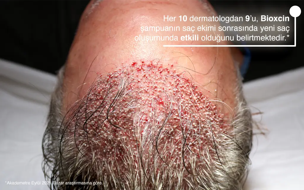 Saç Ekiminden Sonra İyileşme Ne Kadar Sürer?